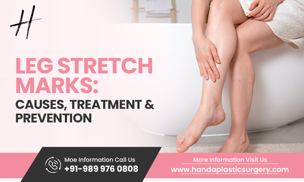 Leg Stretch Marks: Causes, Treatment & Prevention
