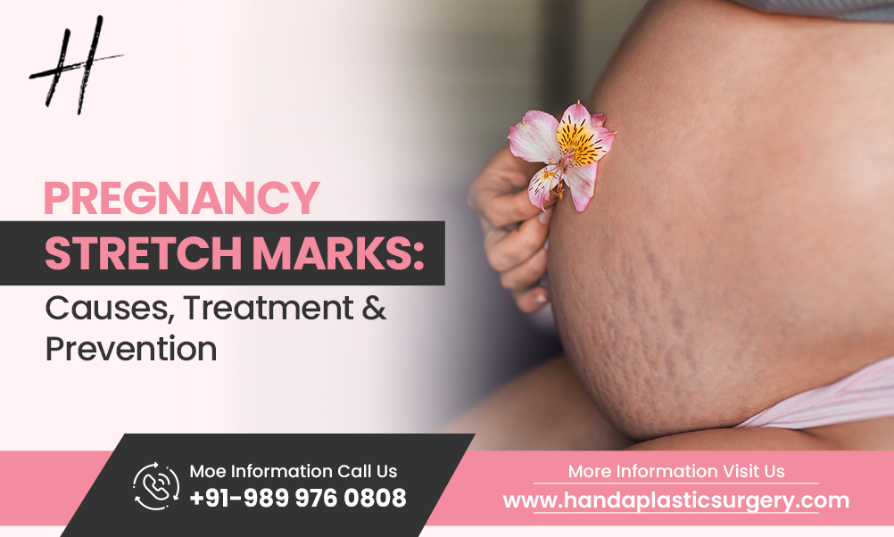 Pregnancy Stretch Marks: Causes, Treatment & Prevention