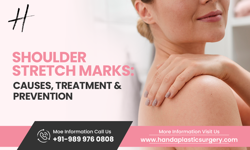 Shoulder Stretch Marks: Causes, Treatment & Prevention